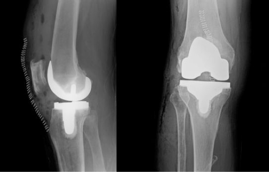 Mako Total Knee Replacement